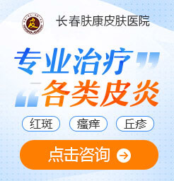 长春皮肤科医院排名,过敏性皮炎应该怎么治疗